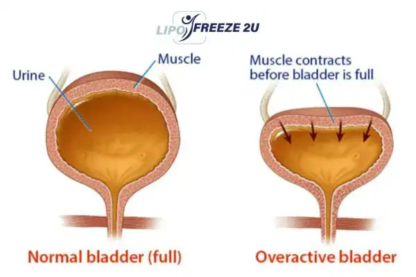 diagram of overactive bladder treatment Higham Ferrers