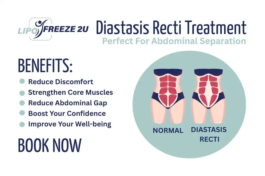 How Long Will It Take to See Improvements in Diastasis Recti Higham Ferrers