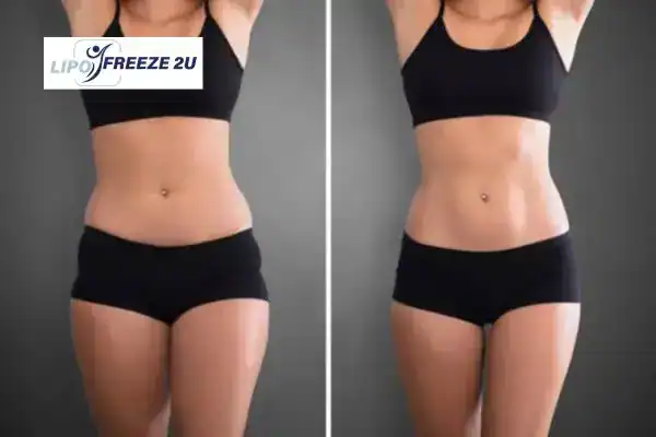 How Can LIPO FREEZE 2U Support Your Post-Pregnancy Body Recovery Higham Ferrers?
