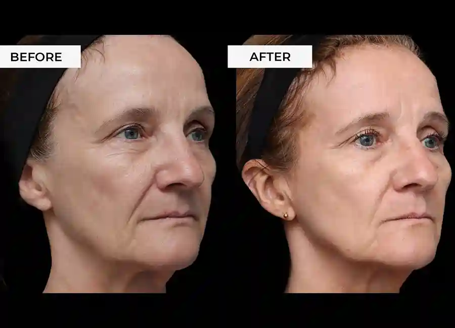 How Many RF Microneedling Sessions Will You Need to See a Difference Higham Ferrers?