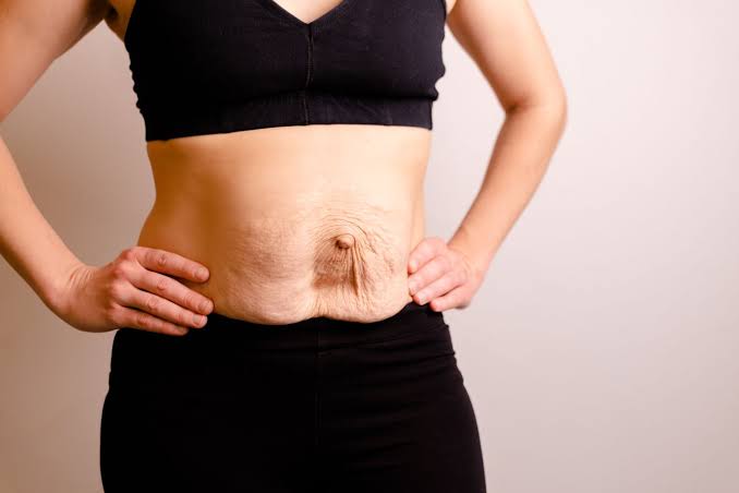 Is Surgery Really the Only Way to Repair Diastasis Recti Higham Ferrers?