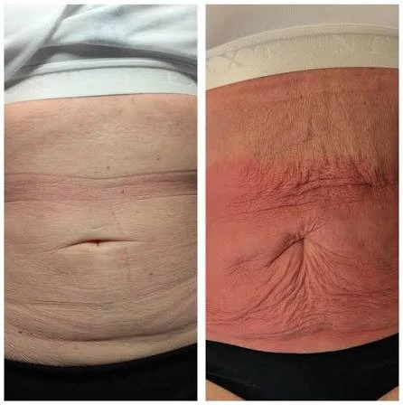 How Does RF Microneedling Improve Crepey, Thin and Uneven Skin Texture Higham Ferrers?