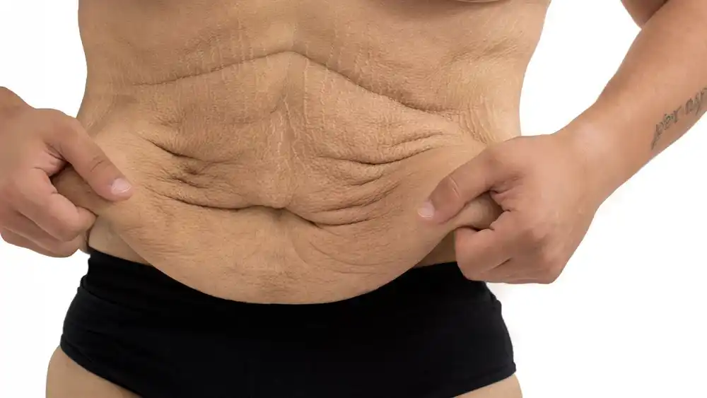 RF Microneedling for Loose Skin: How Can It Help Tighten and Reshape the Skin Higham Ferrers?